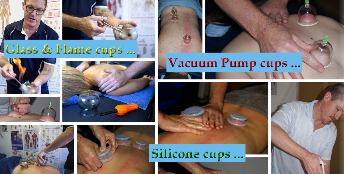  Spotlight on Techniques – Remedial Cupping. 